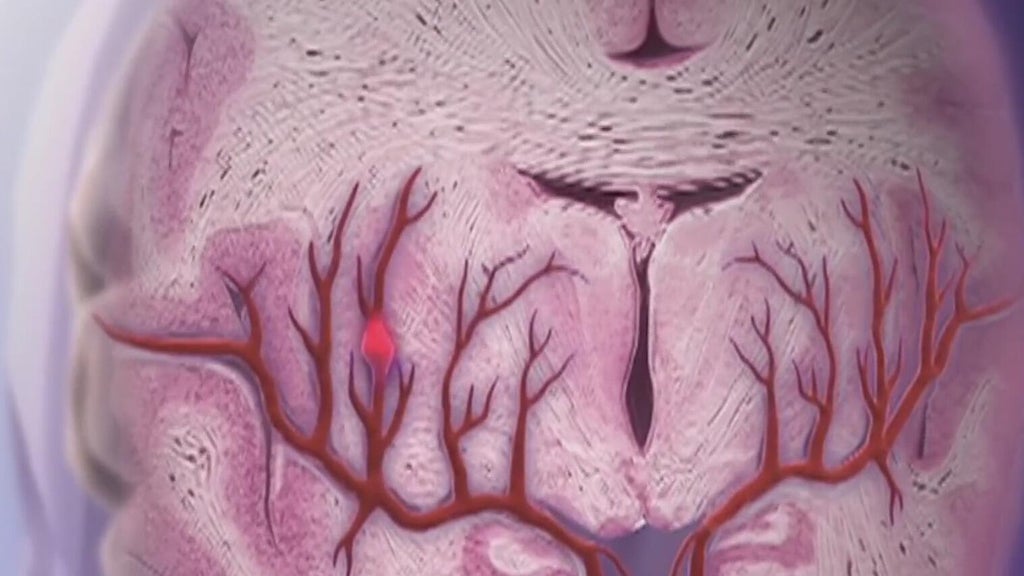 Knowing the signs of a stroke can save lives — Rome Community news